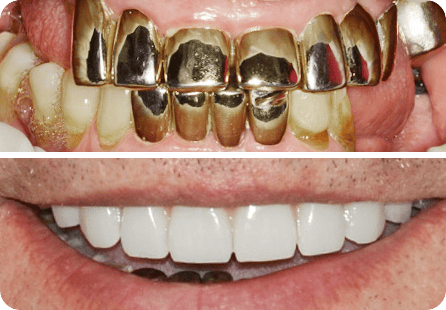 Удаление зубов на верхней челюсти и установка 4х имплантатов Nobel в концепции ALL-ON-4 (ВСЕ-НА-4)