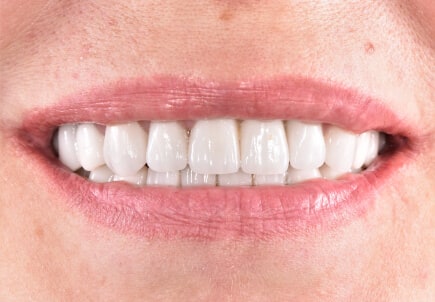 Комплексная реабилитация с установкой имплантатов и виниров на все зубы