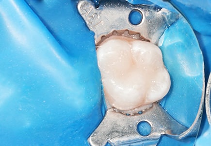Реставрация зуба фотокомпозитным материалом