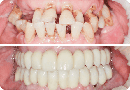 Полная реабилитация по протоколу ВСЕ-НА-6 на обеих челюстях <span>Клинический случай №15</span>
