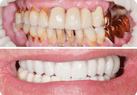 Установка  имплантатов и  цельноциркониевых коронок на все зубы
