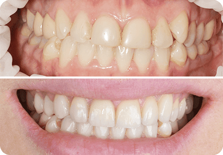 Эстетическая реабилитация с помощью установки 6 виниров на фронтальные зубы