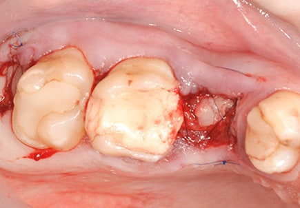 Атравматичное удаление зубов с использованием богатой тромбоцитами плазмы A-PRF и ушиванием лунки зуба