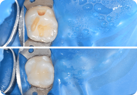 Реставрация зуба фотополимерными материалами <span>Клинический случай №59</span>