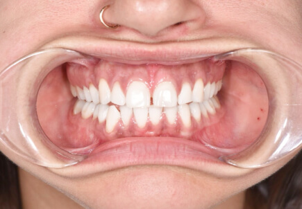 Клиническое отбеливание зубов Philips Zoom 4 White Speed