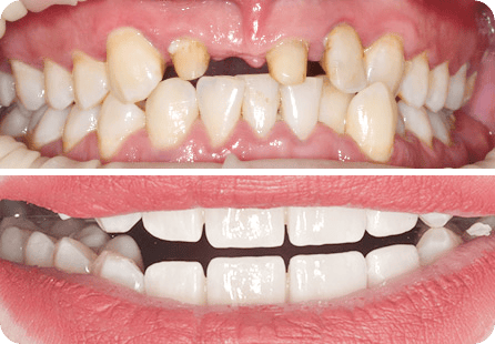 Эстетическая реабилитация с помощью керамических вкладок и коронок в зоне улыбки <span>Клинический случай №5</span>