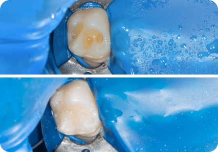 Реставрация зуба фотополимерными материалами <span>Клинический случай №51</span>