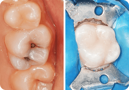 Реставрация зуба фотокомпозитным материалом <span>Клинический случай №11</span>