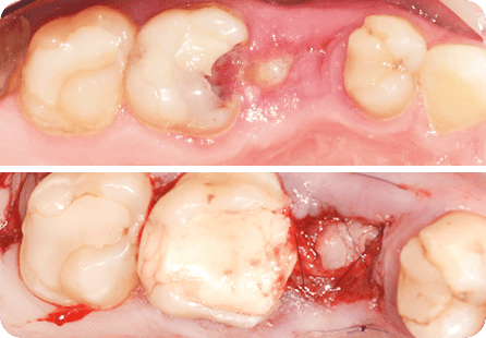 Атравматичное удаление зубов с использованием богатой тромбоцитами плазмы A-PRF и ушиванием лунки зуба <span>Клинический случай №4</span>