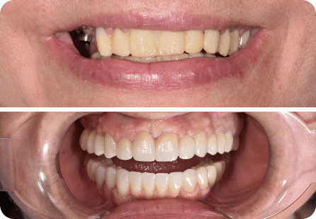 Установка постоянных цельноциркониевых реставраций на зубы и имплантаты <span>Клинический случай №55</span>