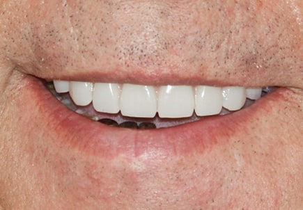 Удаление зубов на верхней челюсти и установка 4х имплантатов Nobel в концепции ALL-ON-4 (ВСЕ-НА-4)