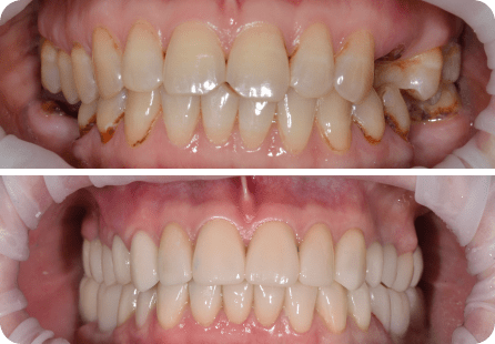 Установка 23 керамических коронки Emax на зубах и 5 на имплантатах <span>Клинический случай №45</span>
