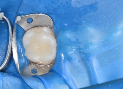 Реставрация зуба фотополимерными материалами