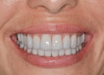 Комплексная реабилитация с установкой имплантатов и виниров на все зубы