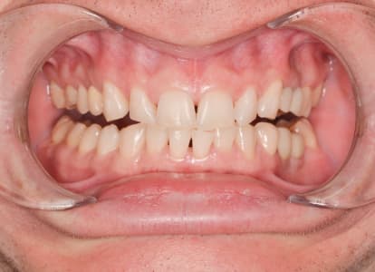 Клиническое отбеливание зубов Philips Zoom 4 White Speed