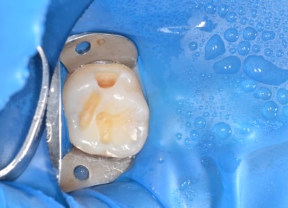 Реставрация зуба фотополимерными материалами