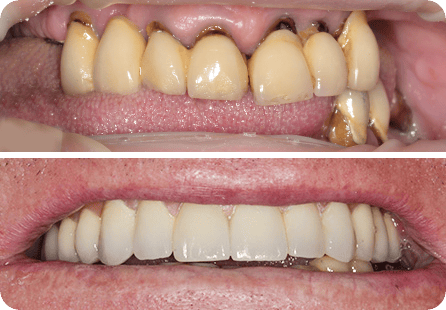 Удаление зубов, установка 6 импланатов и 12 керамических коронок на титановой балке <span>Клинический случай №2</span>
