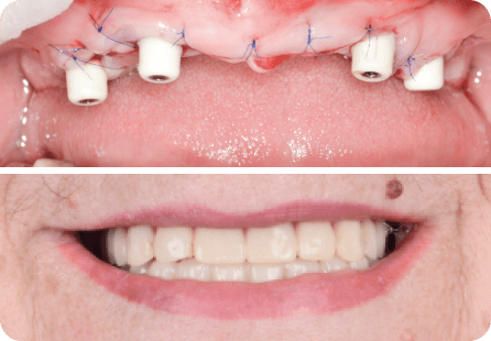 Полная реабилитация обоих челюстей <span>Клинический случай №23</span>